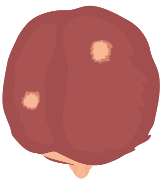 Hårtab - pletskaldethed