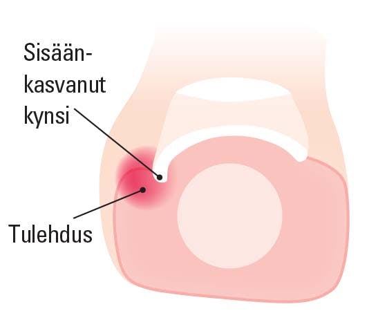 Sisäänkasvanut kynsi - poikkileikkaus