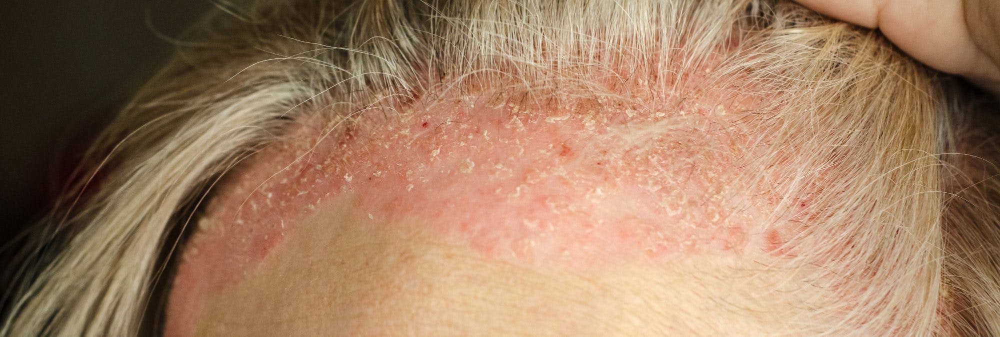 Skyldes din tørre hovedbund psoriasis, kan disse råd komme dig til undsætning