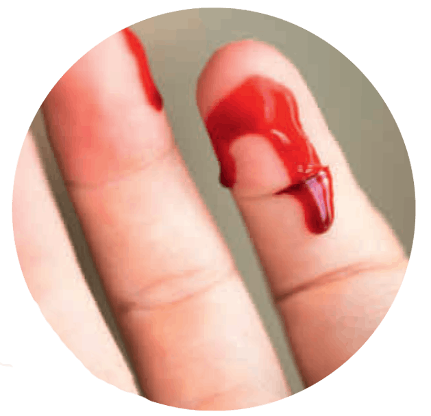 Akuutti vamma - haava sormessa