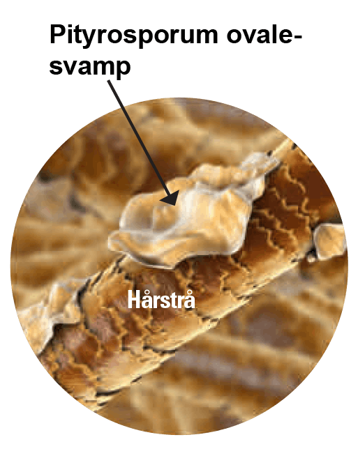 Pityrosporum-ovalesvamp