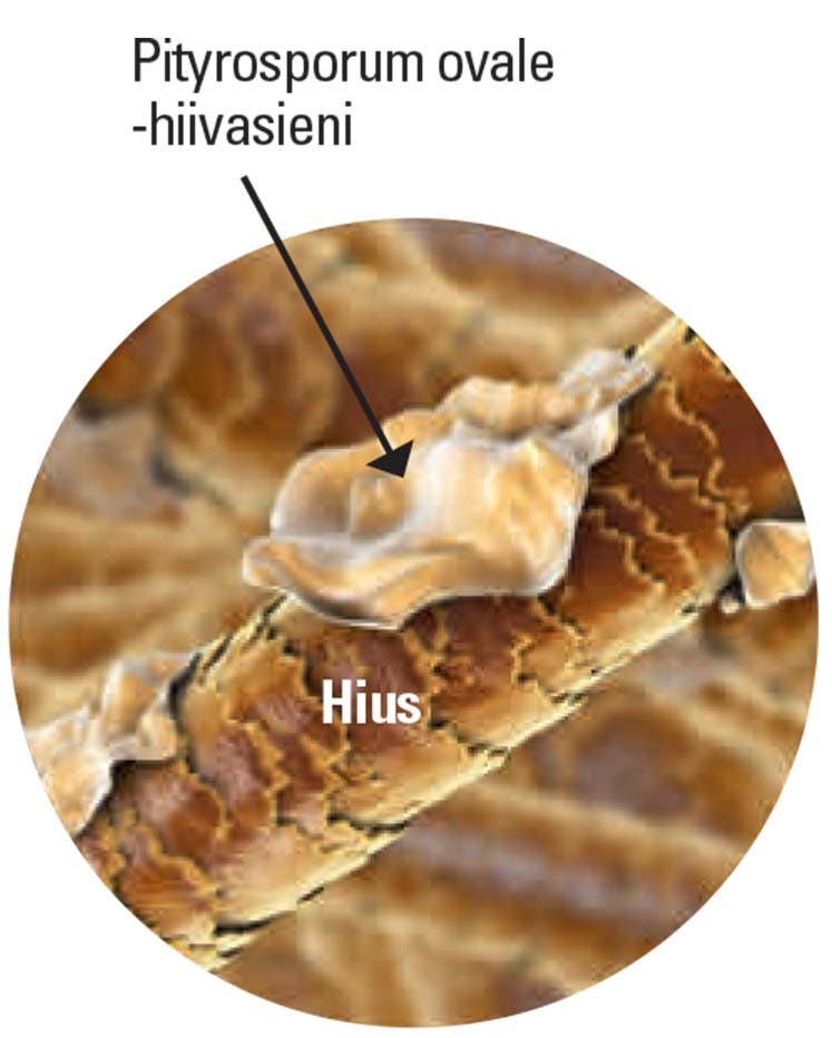 Pityrosporum ovale -hiivasieni