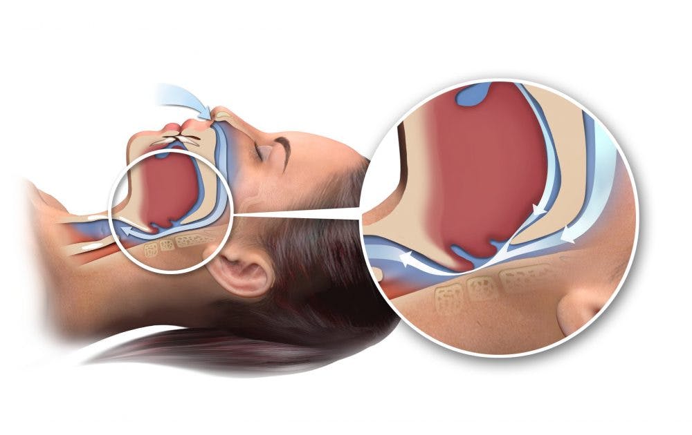 Snorken skyldes at der er snævert med plads i svælget.