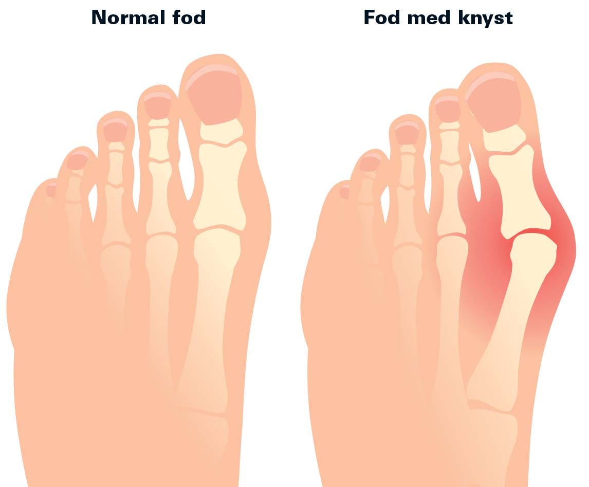 normal fod vs knyst fod grafik