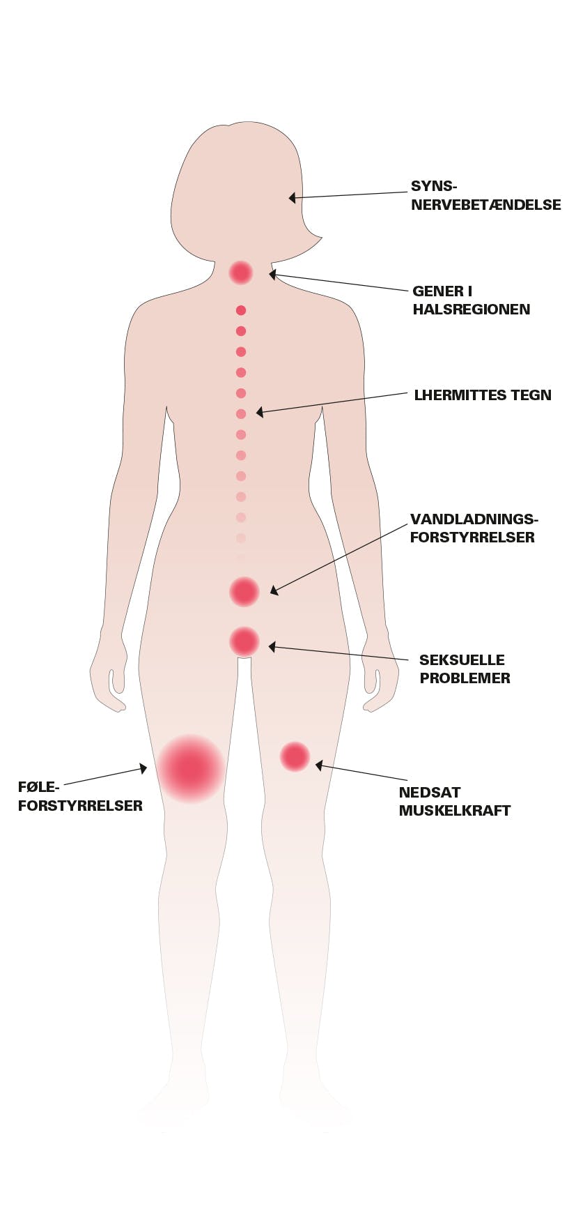Figur af symptomer på sclerose