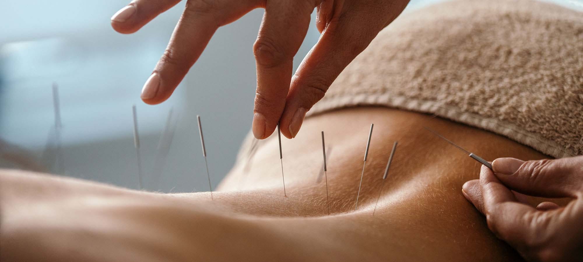 Kvinna som får akupunktur