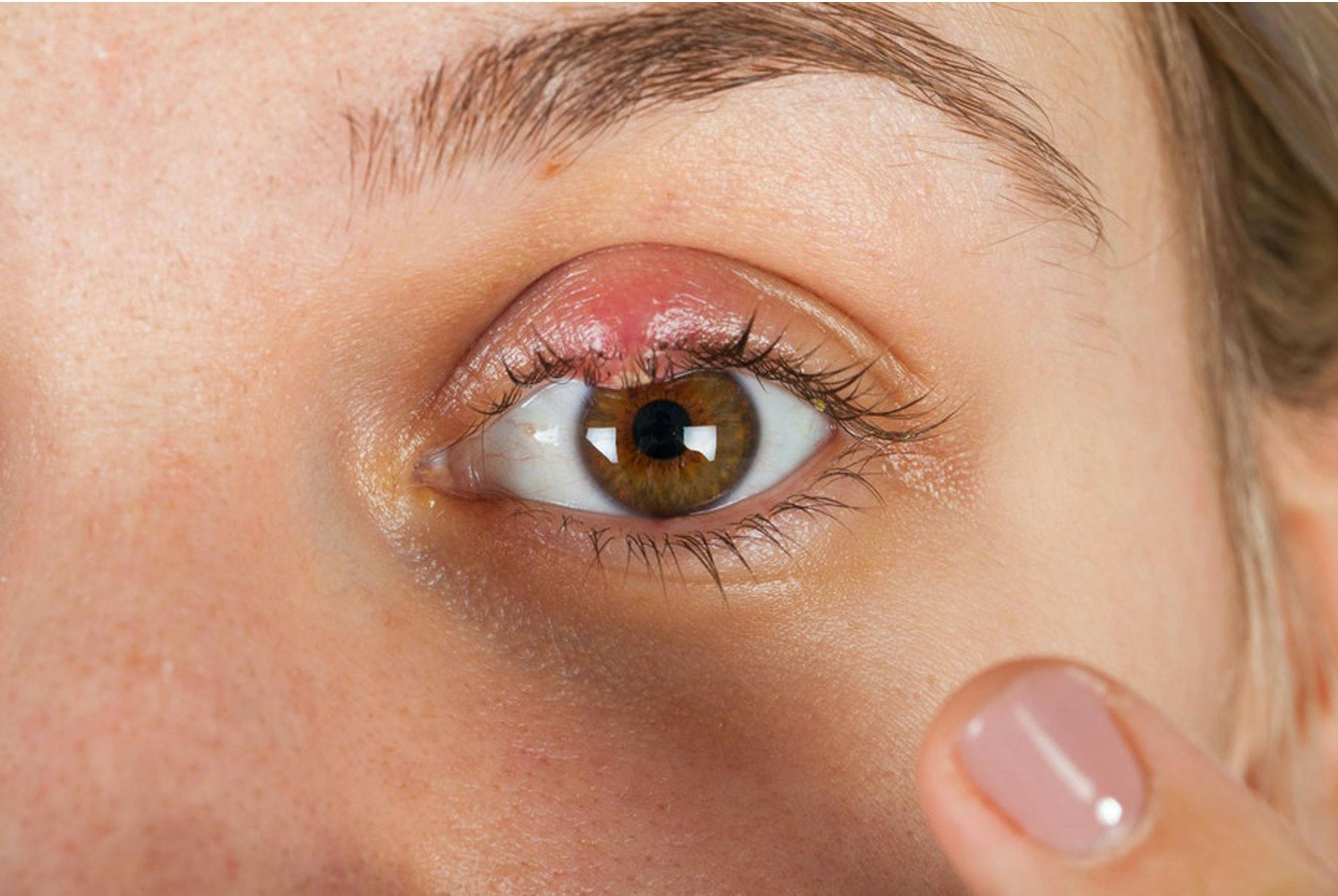 Tulehtunut näärännäppy