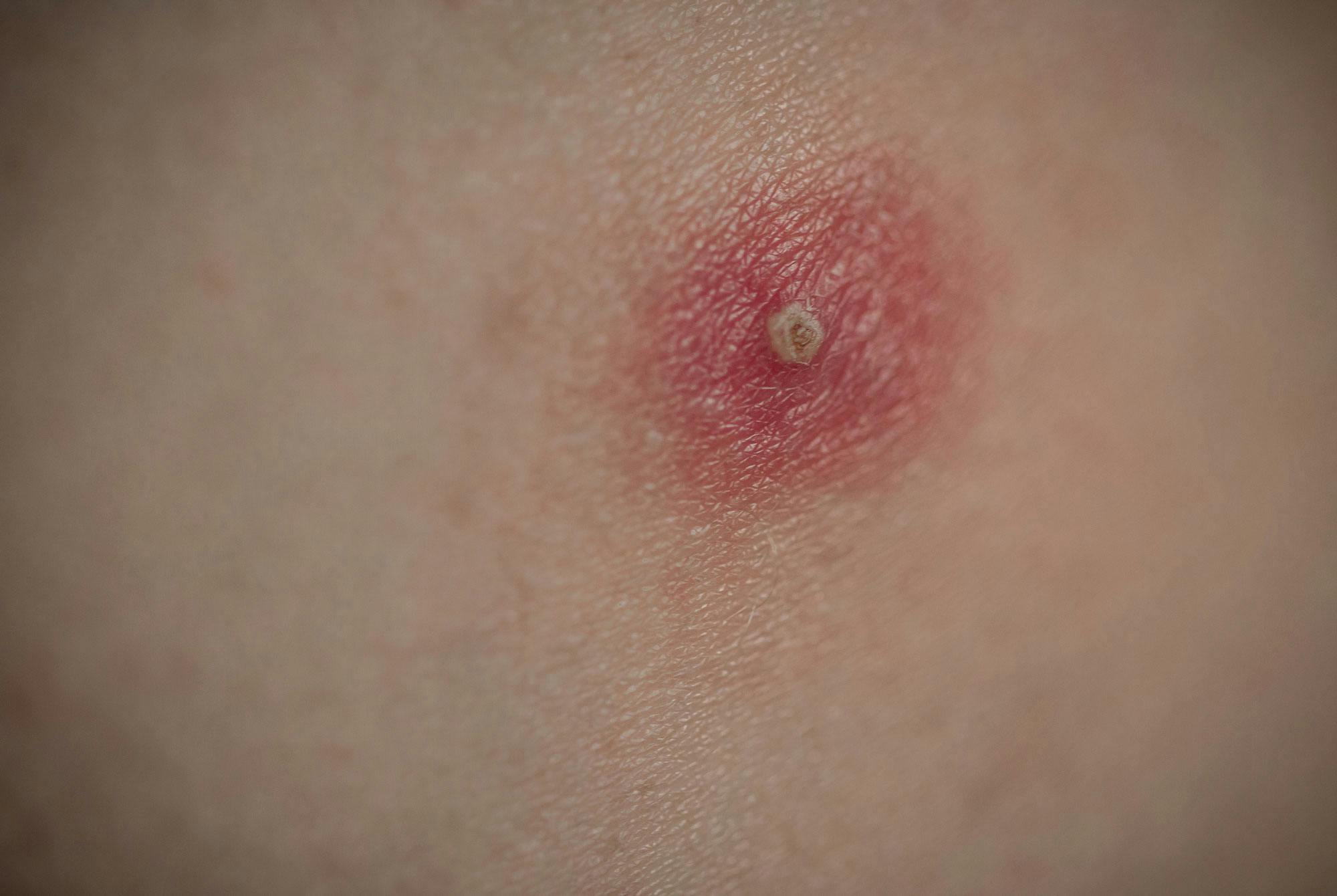 Bilder av stafylokokker i huden: Stafylokokker i sår