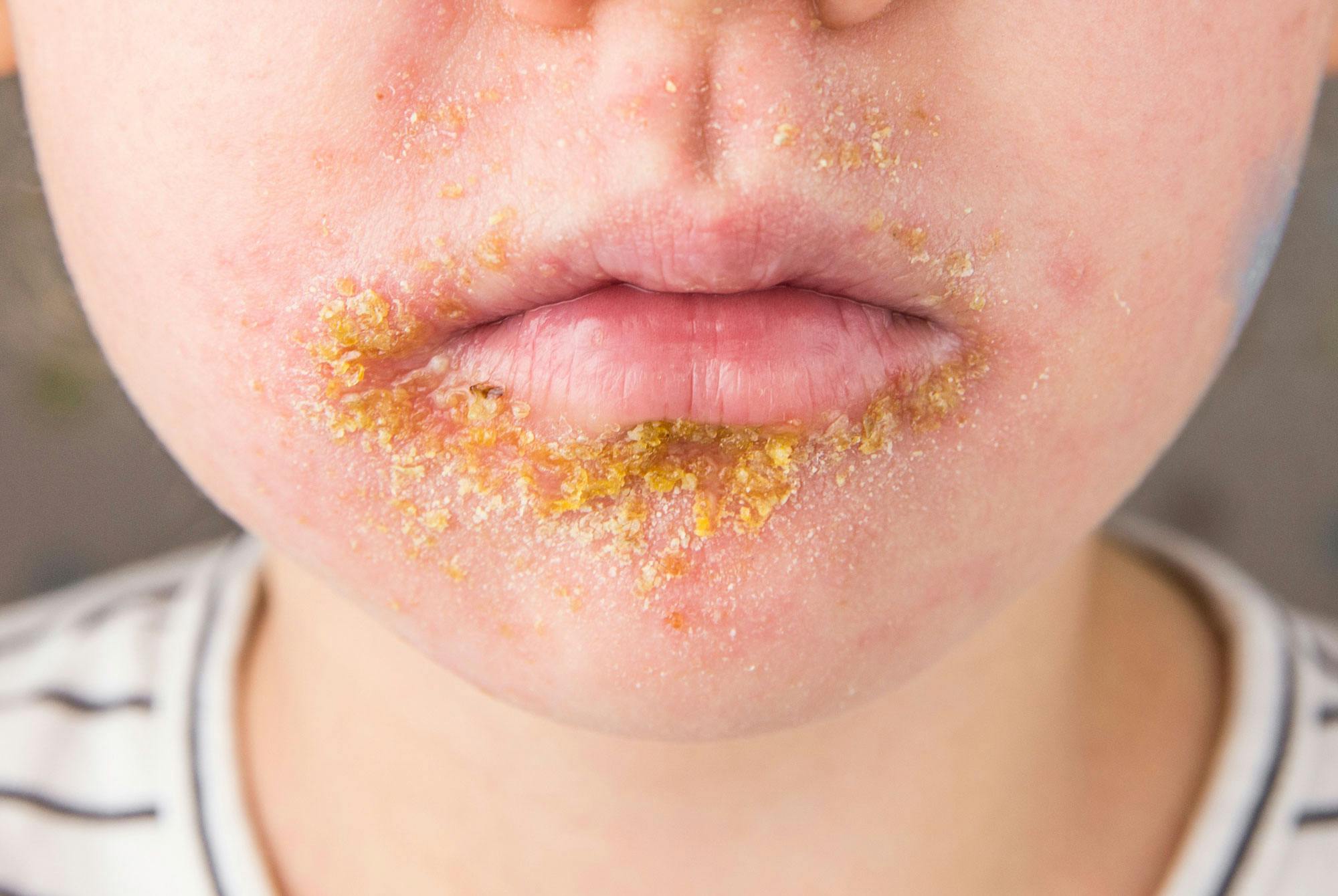 Bilder av stafylokokker i hud stafylokokker i sår