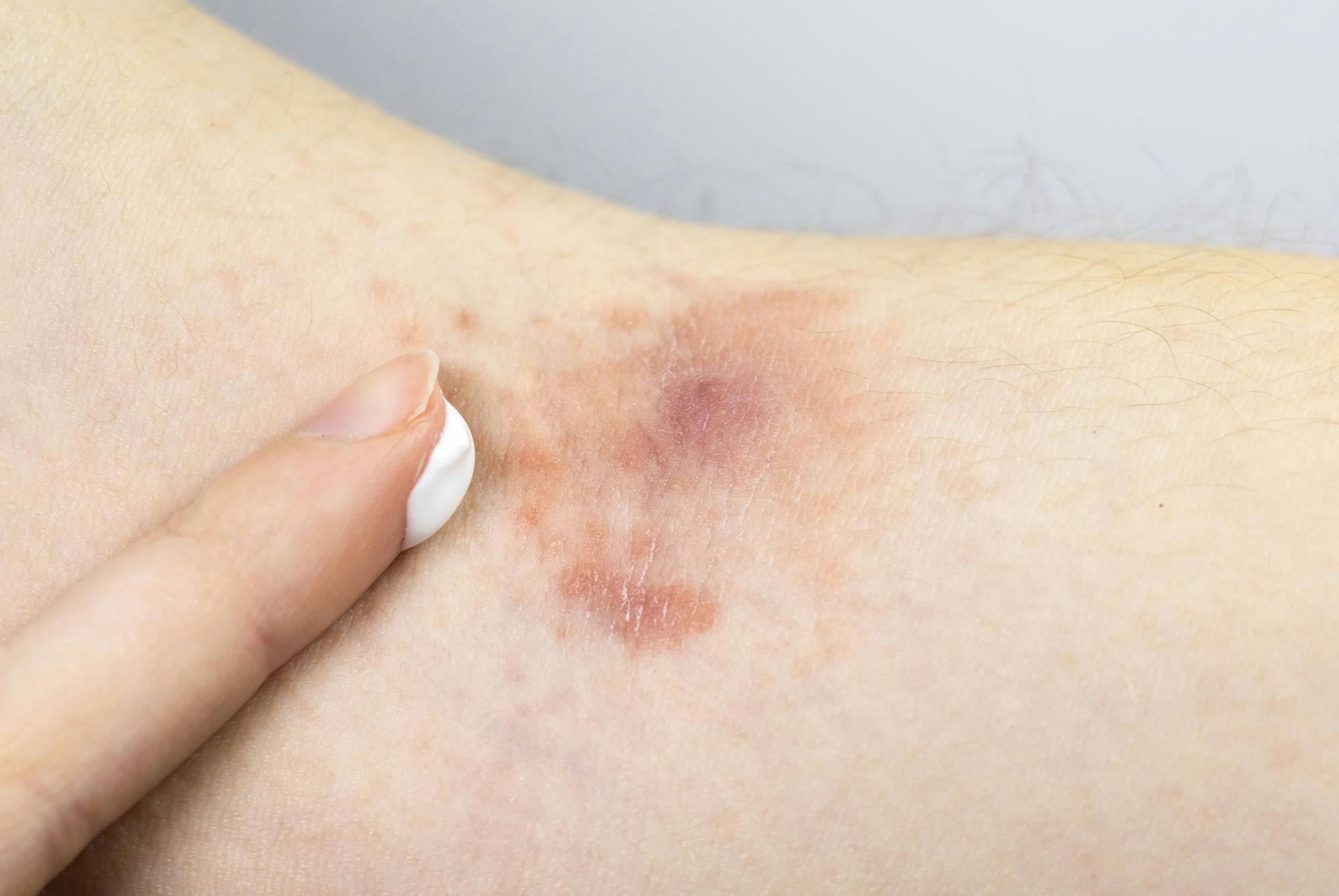 Bilder av stafylokokker i hudsår