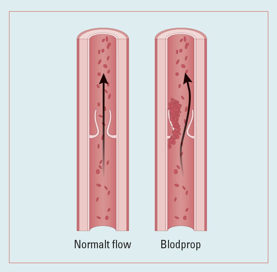 Illustration af vene med normalt flow vs. en vene med blodprop
