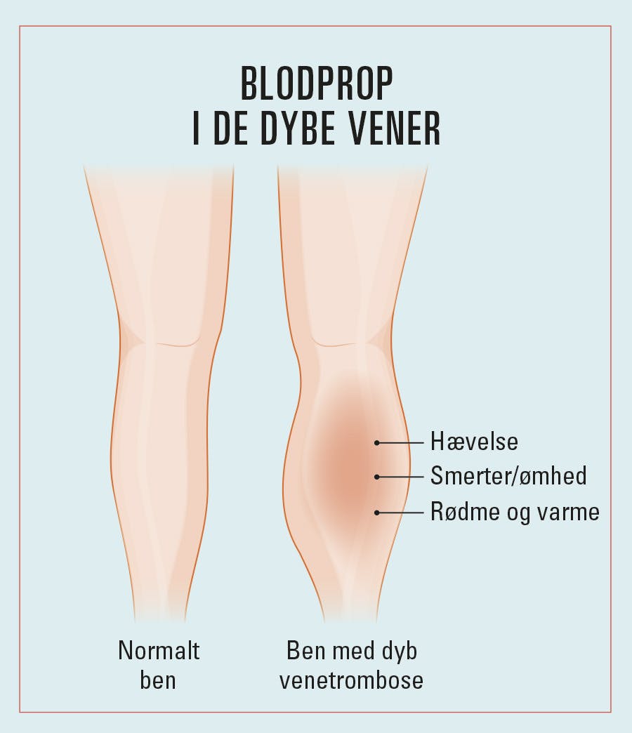 Illustration af ben med en blodprop i de dybe vener, dyb venetrombose