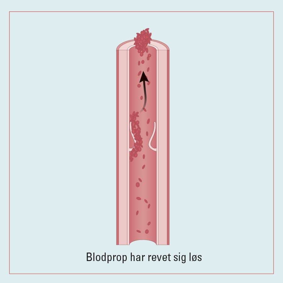 Illustration af blodprop i benet, der river sig løs