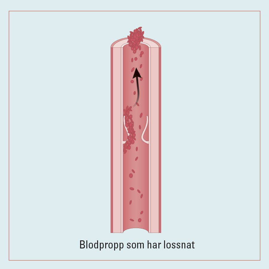 Illustration av blodpropp i benet, som har lossnat