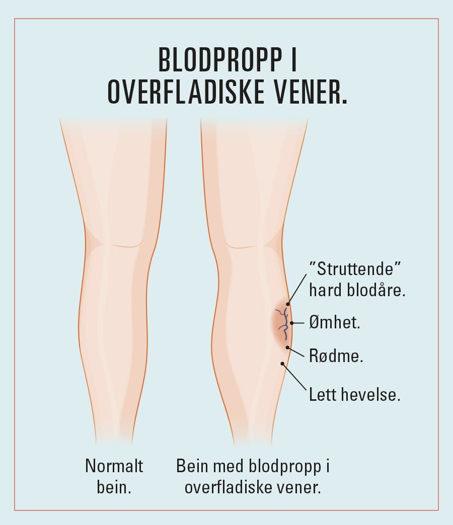 Illustrasjon av bein med overfladisk blodpropp i beinet