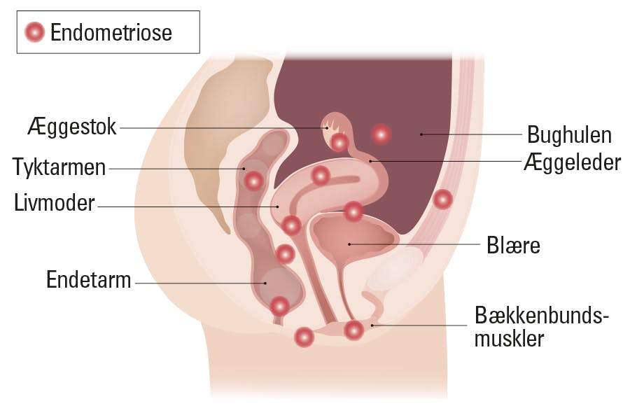 Illustration over placering af endometriose