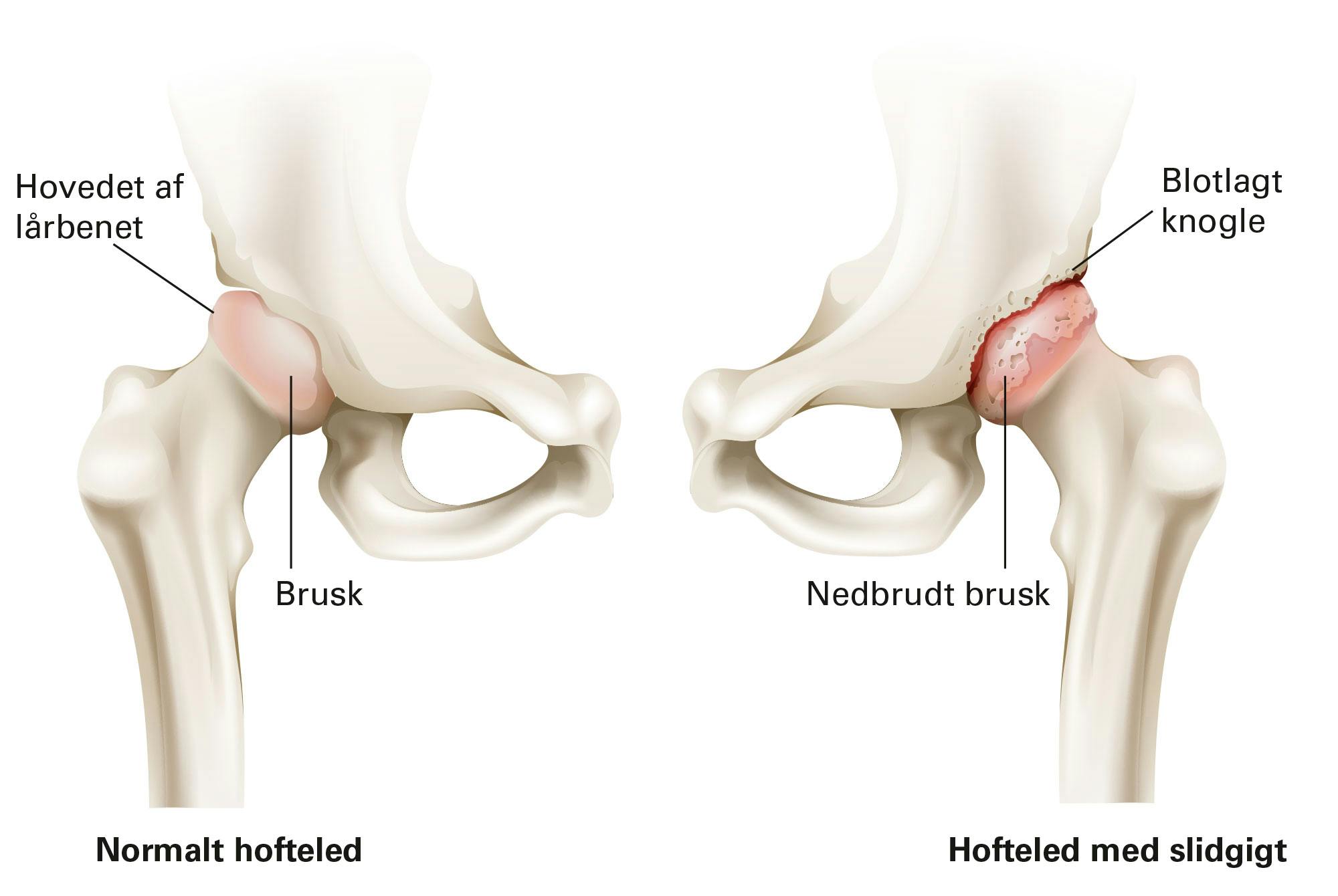 Grafik af slidgigt i hoften