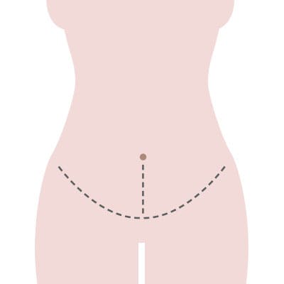 Piirros vatsalihasten erkauman leikkausviilloista