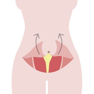 Piirros vatsalihasten erkauman leikkauksesta