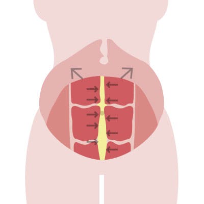 Piirros vatsalihasten erkauman leikkauksesta