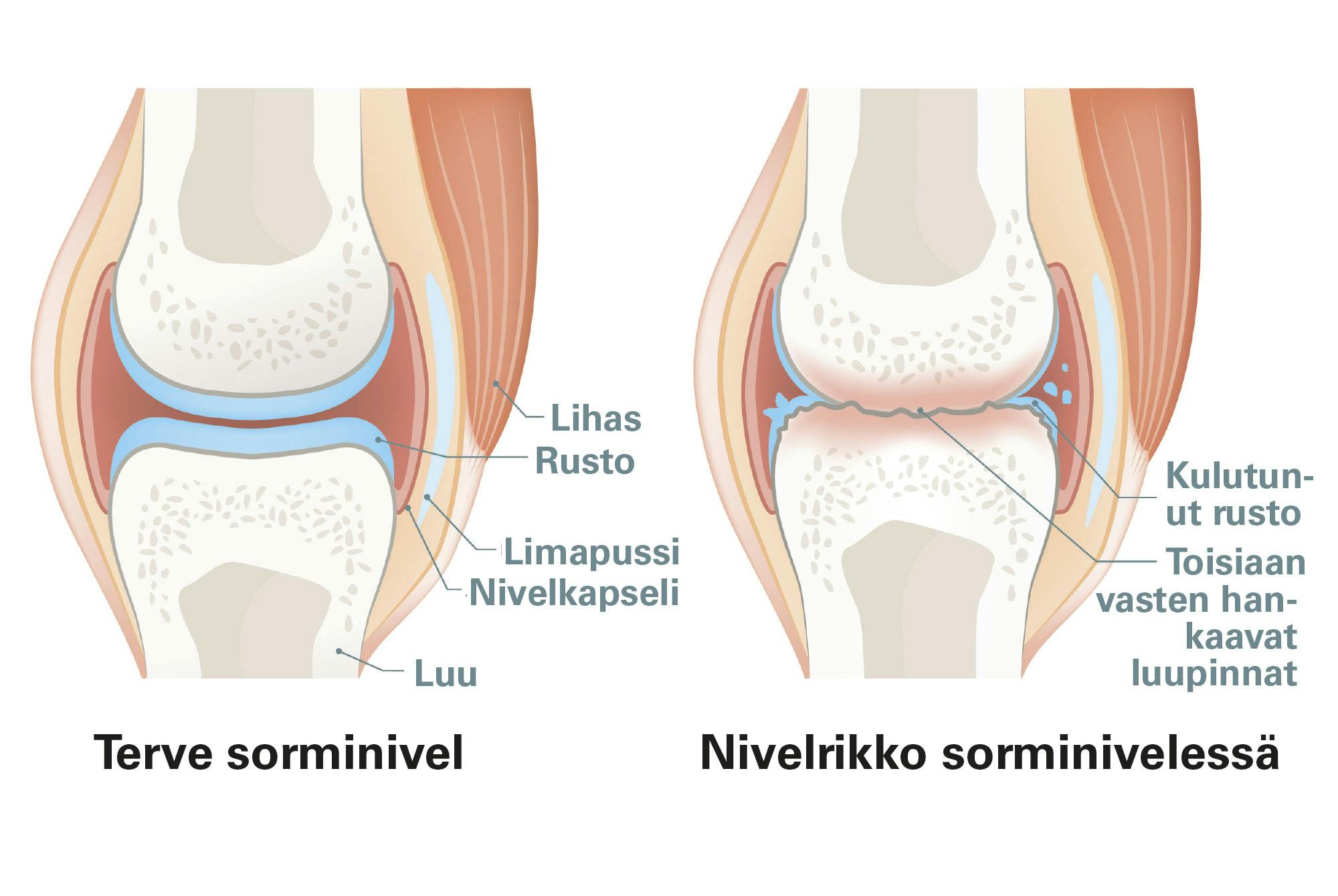 Kuva terveestä ja nivelrikkoisesta sorminivelestä.