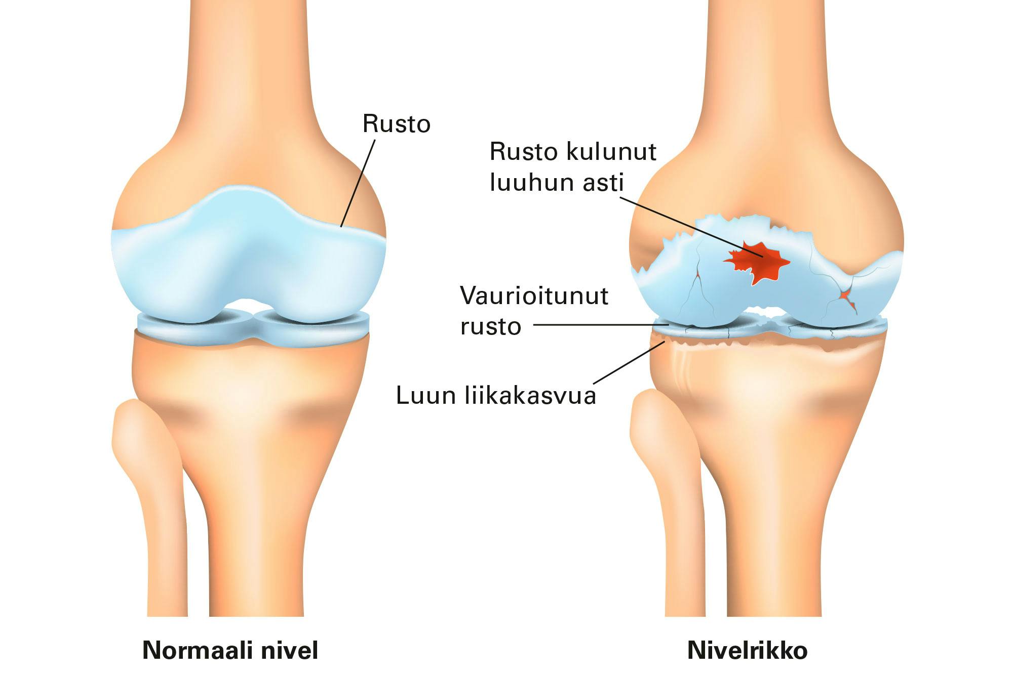 Piirros nivelestä, jossa on nivelrikko