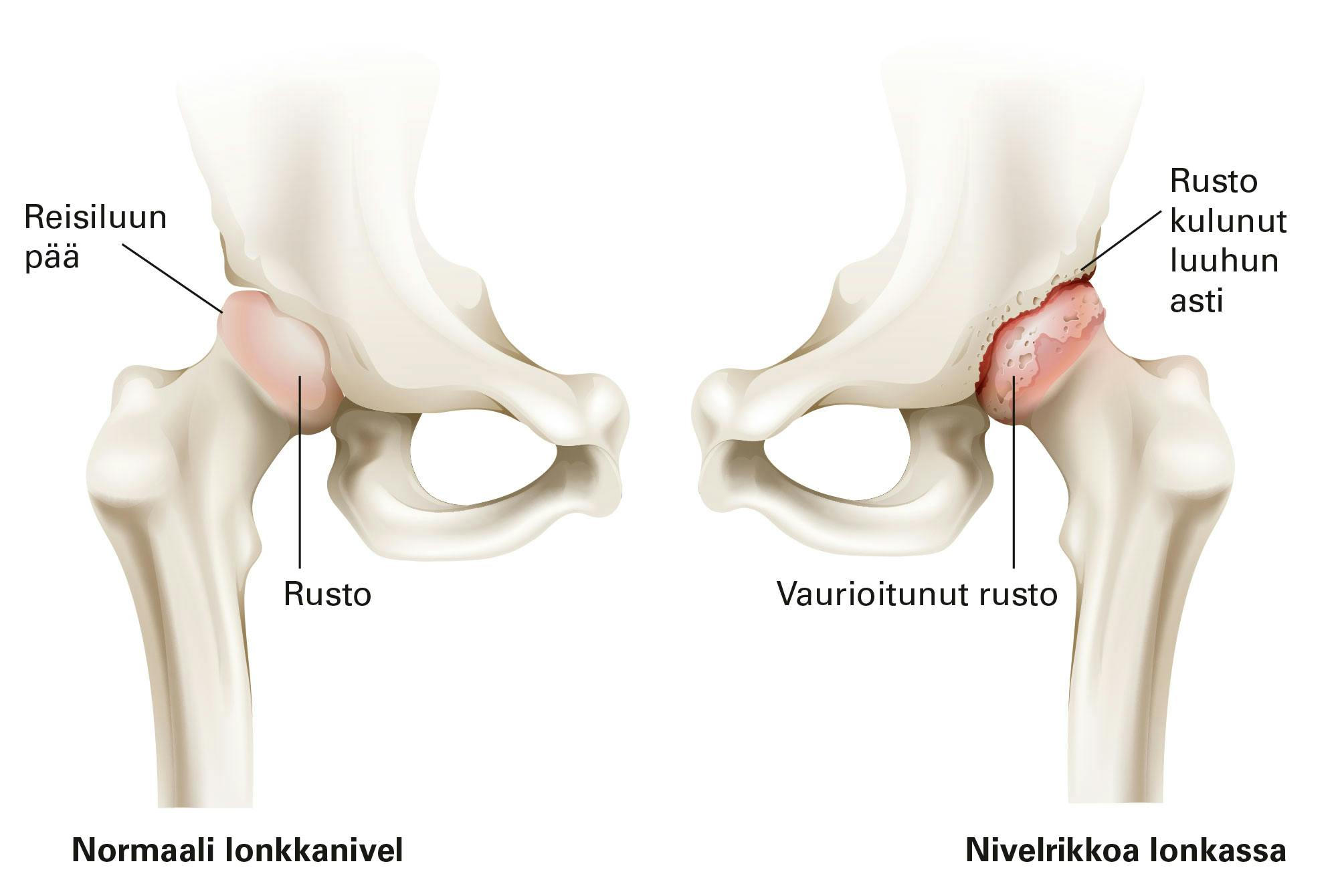 Kuva lonkan nivelrikosta.