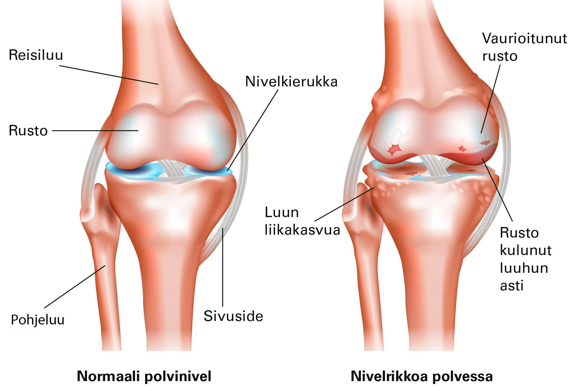 Grafiikka polvinivelen nivelrikosta.