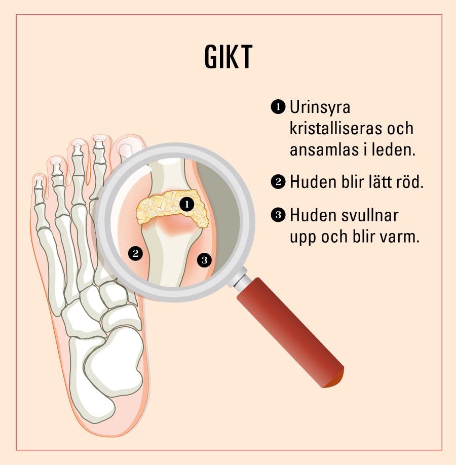 Gikt i fingrarna hos en kvinna. Attacker i fötterna kallas podager.