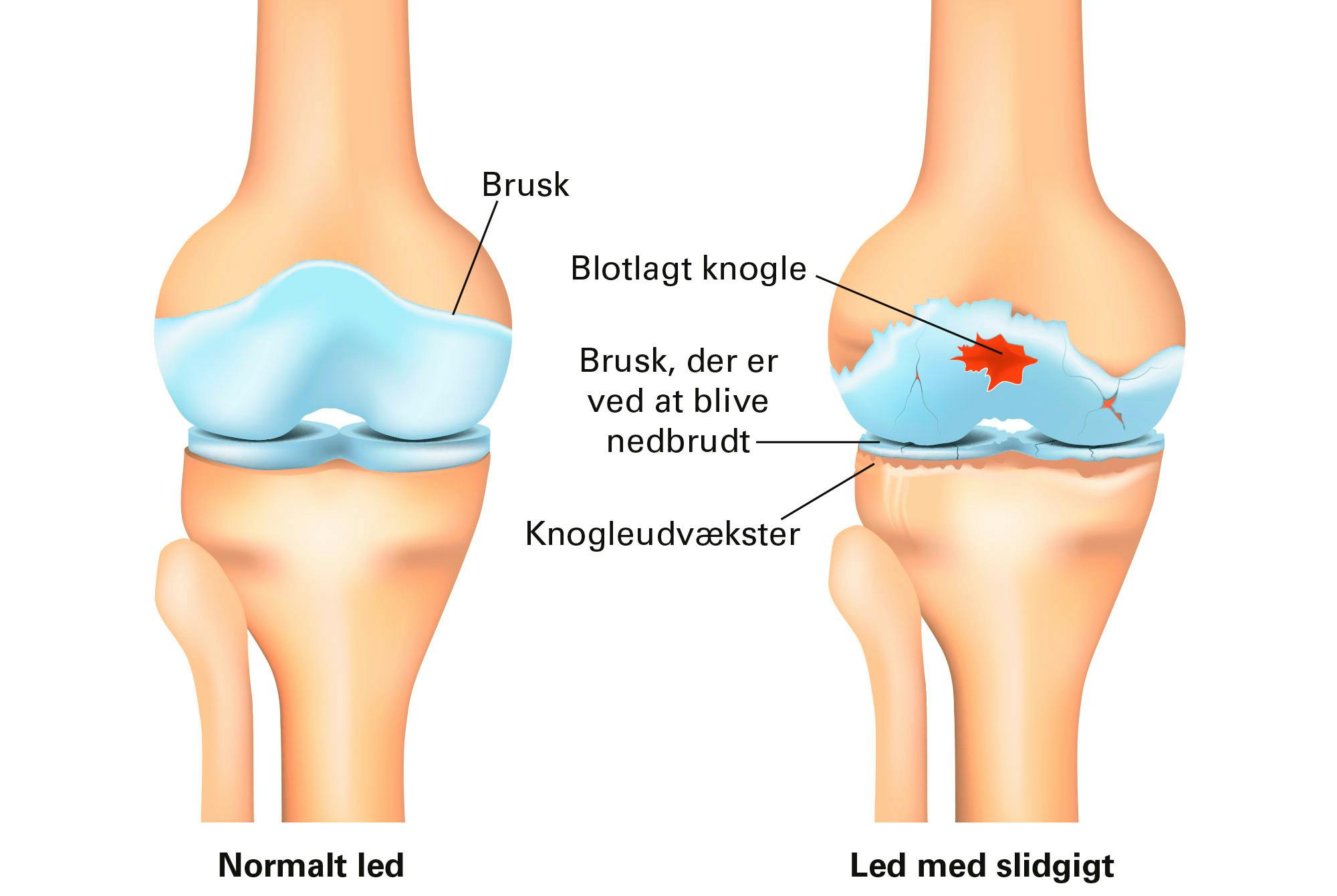 Grafik over led med slidgigt