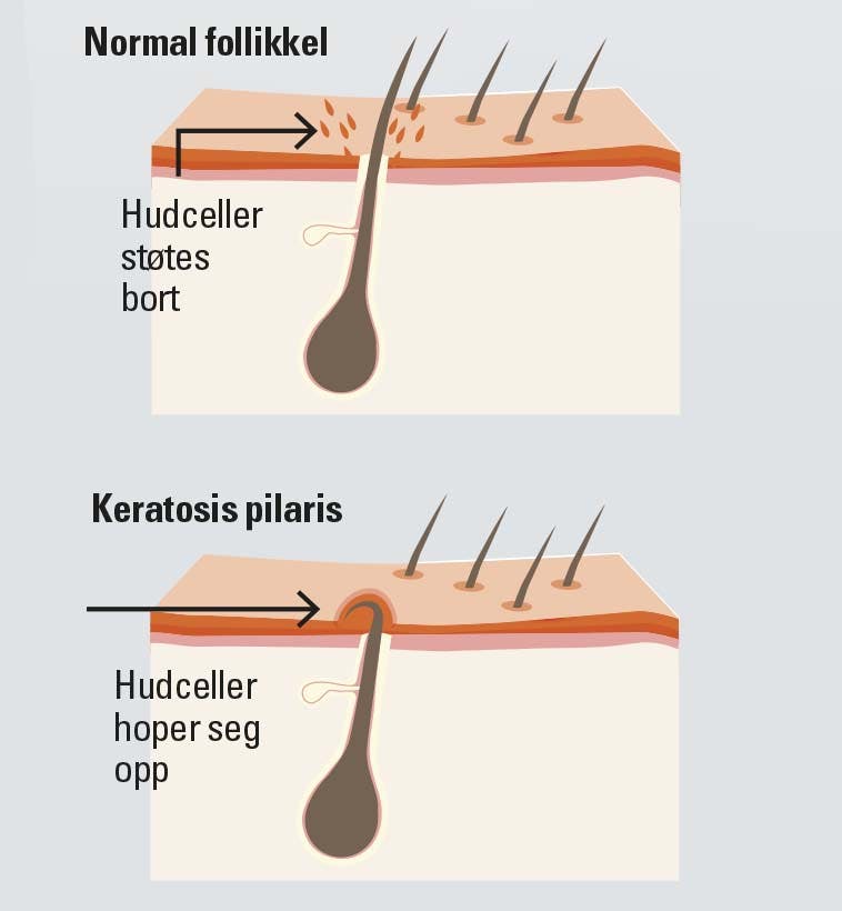 overflaten til en normal hud