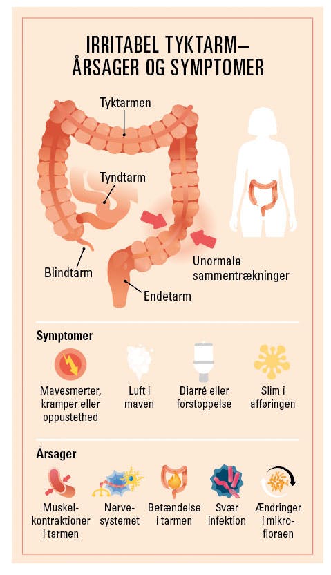 Grafik/Illustration viser årsager og symptomer på irritabel tyktarm (IBS)