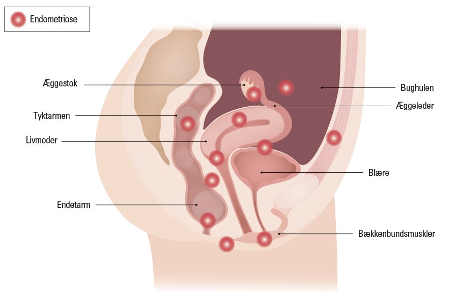 Illustration af placeringen af endometriose
