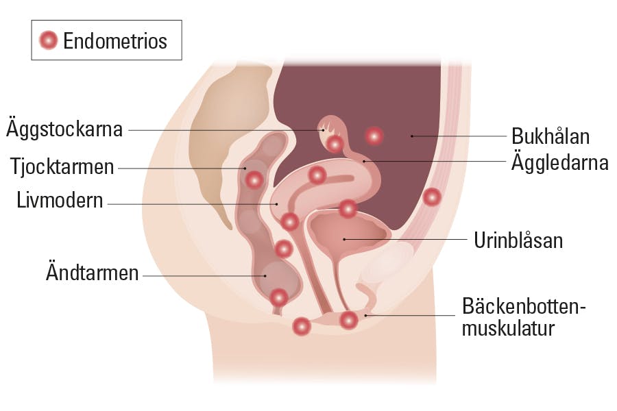 Illustration av placeringen av endometrios