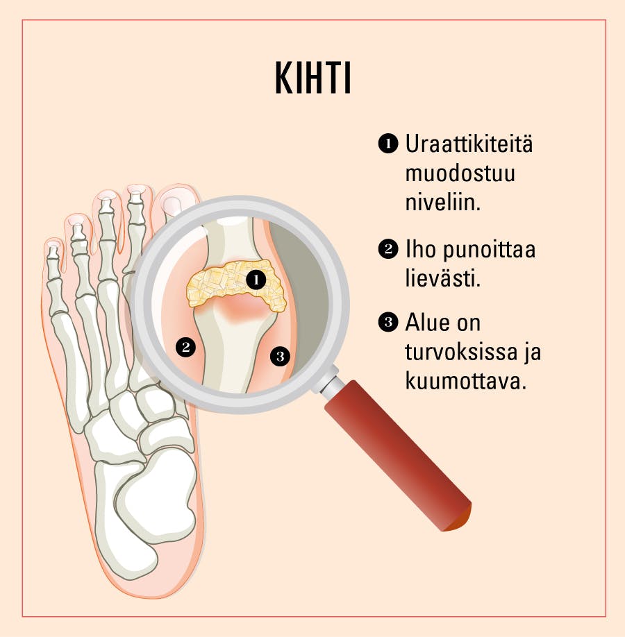 Naisen sormissa esiintyvä kihti.