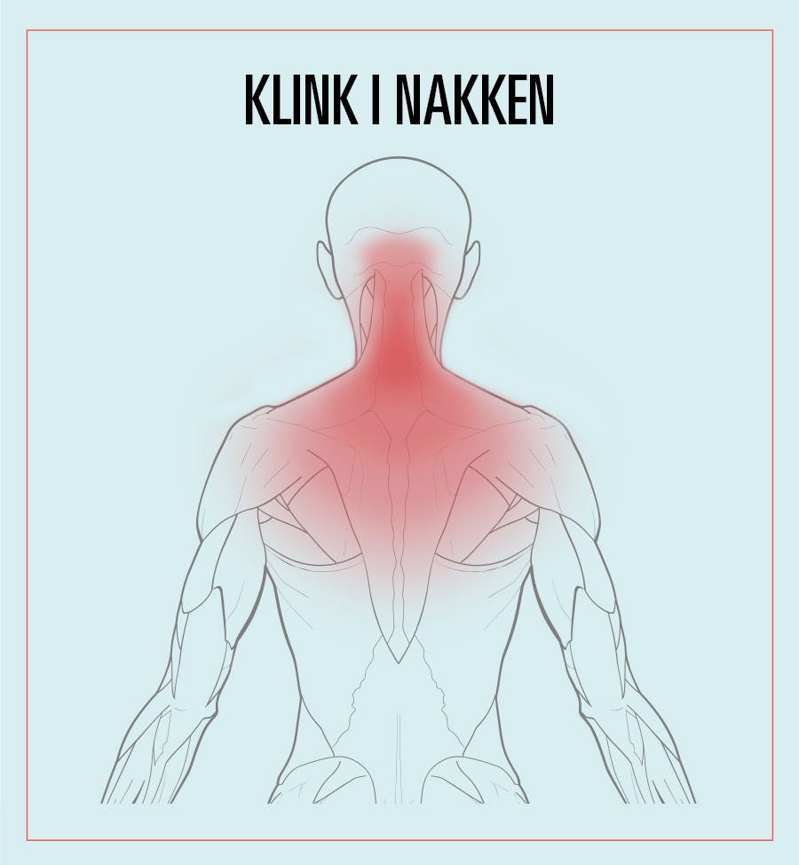 Illustrasjon av nakkesmerter