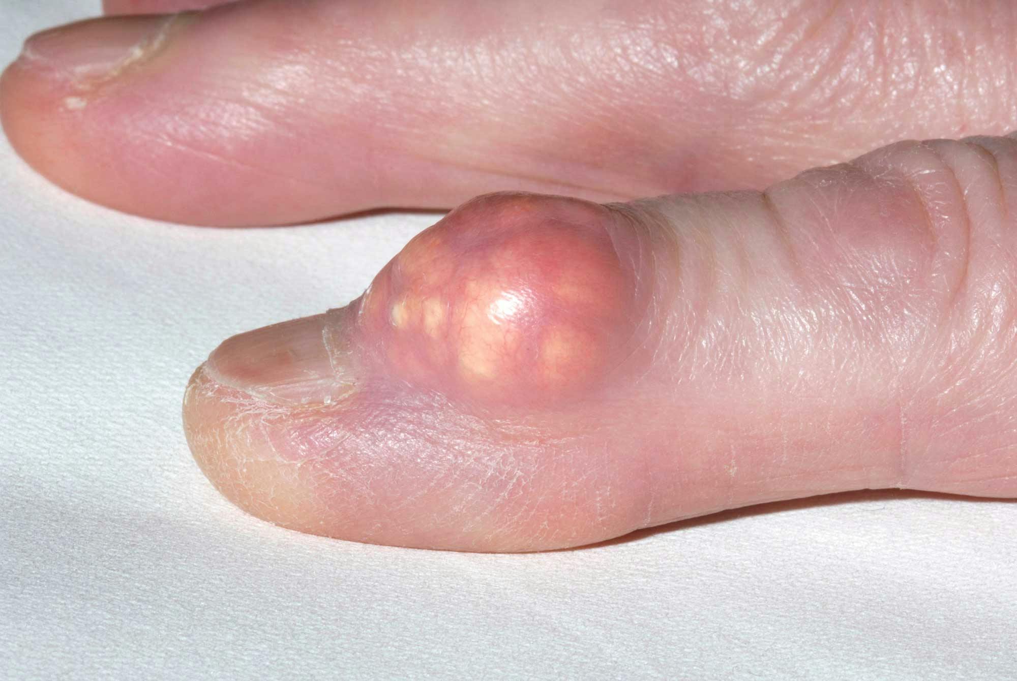 Urinesyregigt er lavet til krystaller, der har hobet sig op i et fingerled på en kvinde.