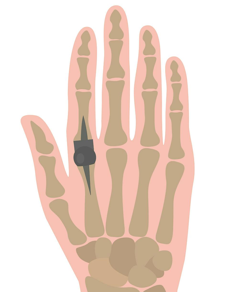 Kunstig leddgrafikk for fingeren