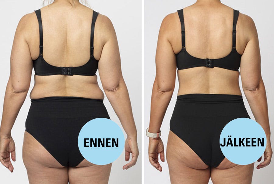 Ruokavalion teho – Louise ennen ja jälkeen 6 viikkoa KUNTO PLUS Ruokavaliolla