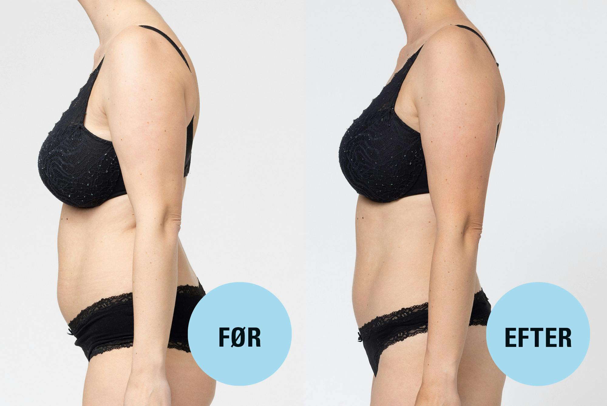 Side by side før efter foto af mavefedt case