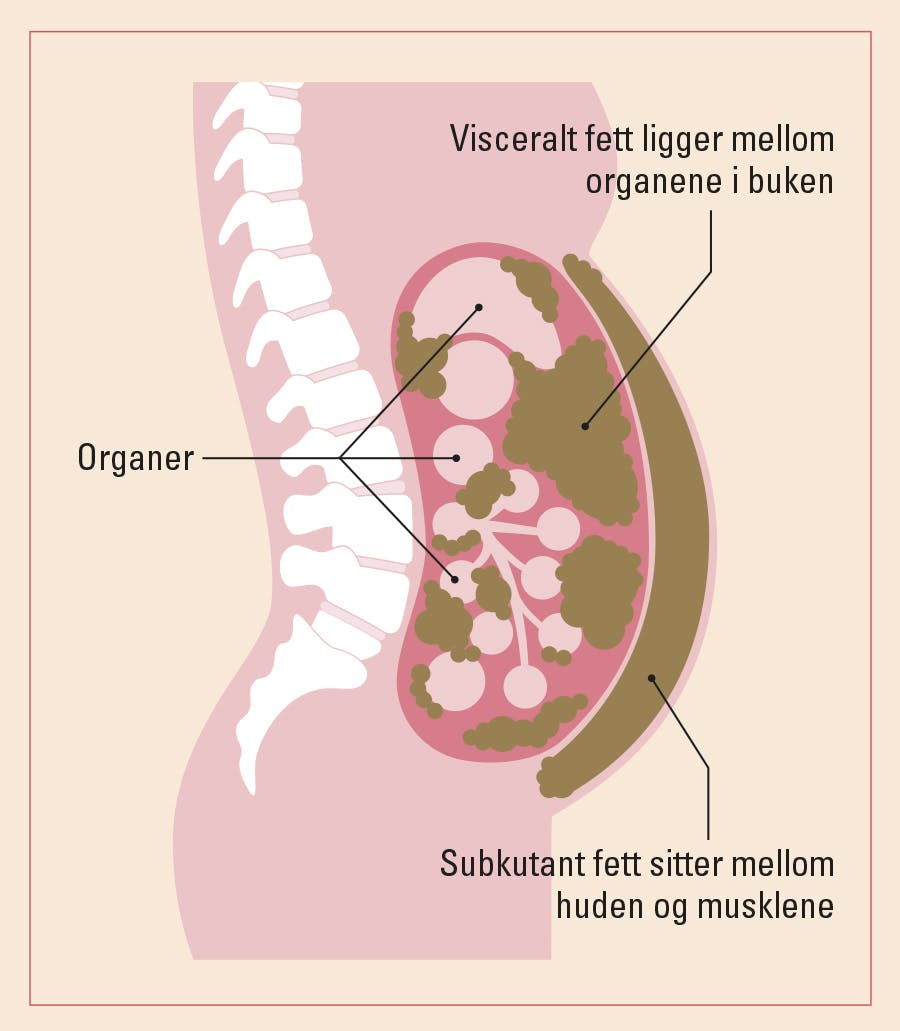 Illustrasjonen viser fordelingen mellom indre og ytre fett – visceralt og subkutant fett