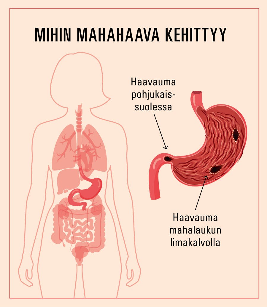 Piirroskuva vatsahaavan ilmenemispaikoista.