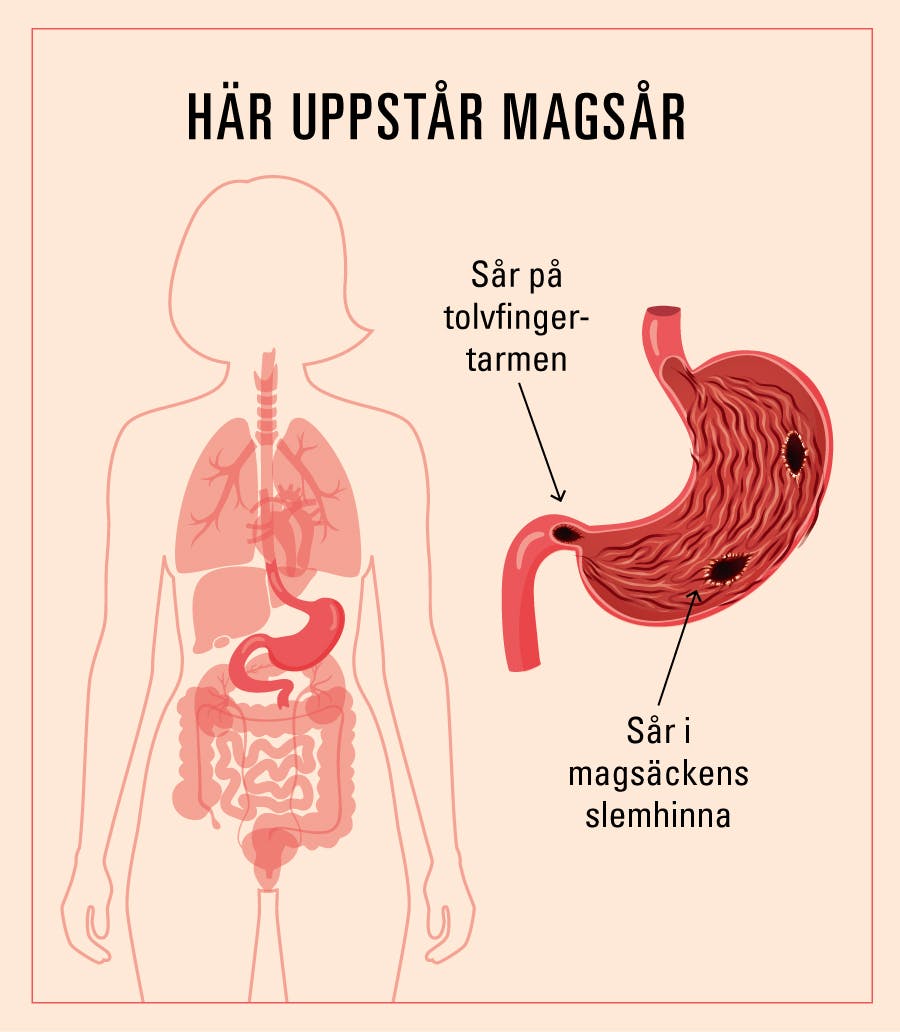 illustrationen visar magsårens placering i slemhinnan