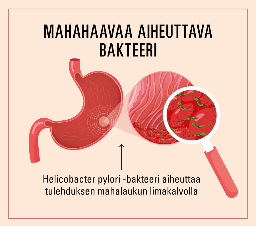 Helicobacter pylori -bakteerin aiheuttamia oireita.