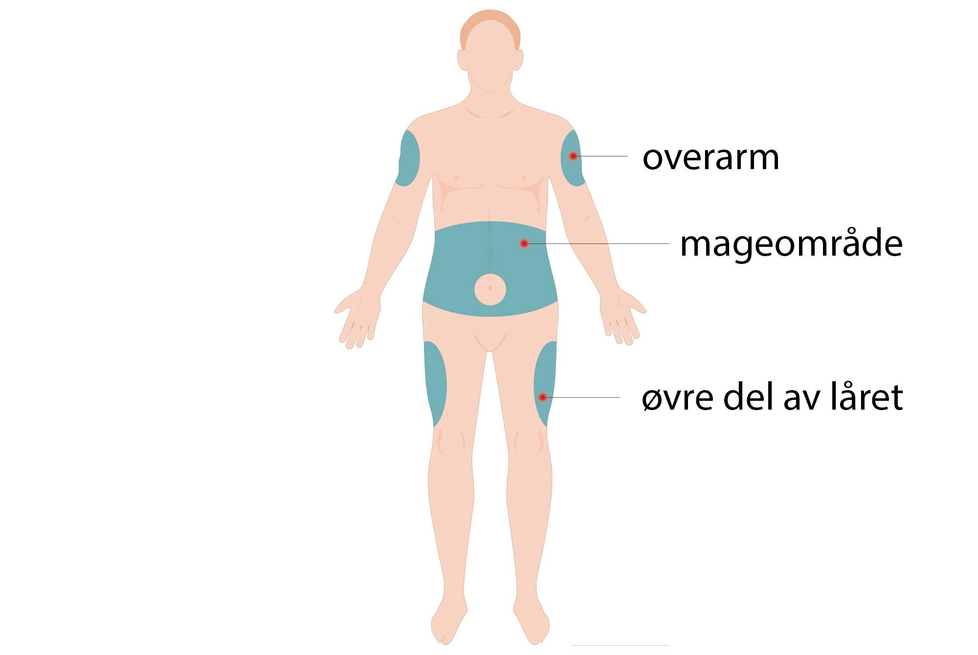 Figur Mounjaro injeksjonssteder