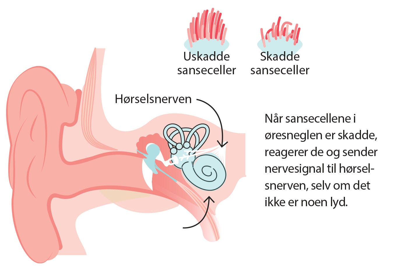 Illustrasjon av hvorfor du får susing i ørene