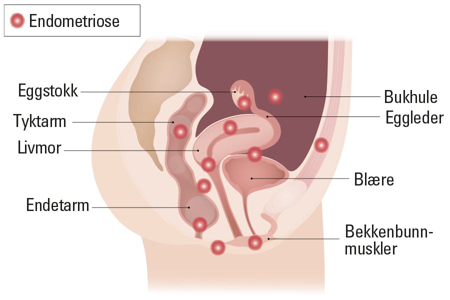 Illustrasjon av hvor endometriosen er lokalisert