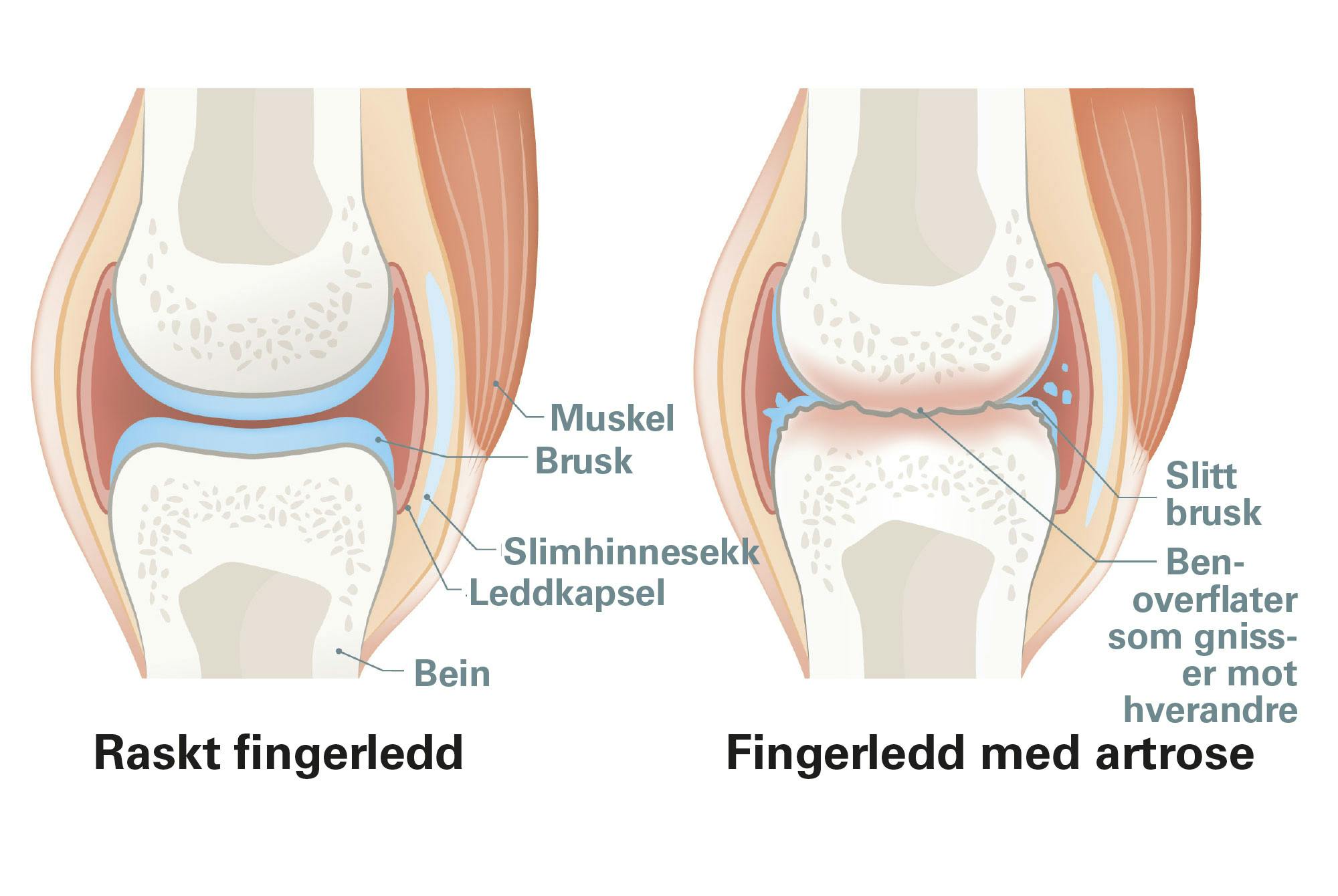 Grafisk fremstilling av artrose i fingrene