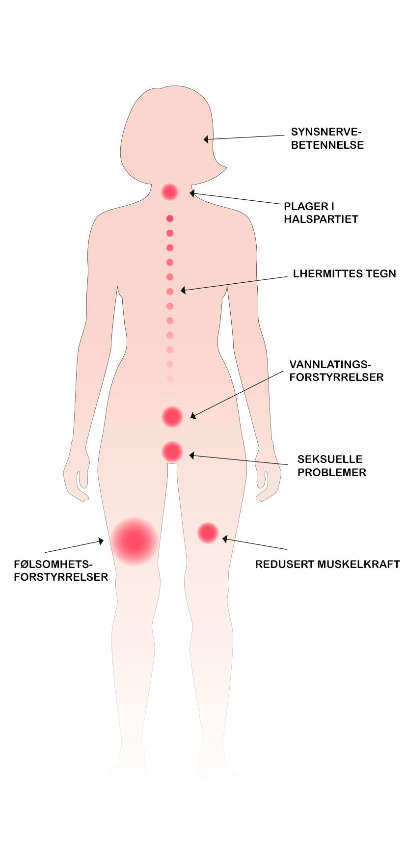 Figur med symptomer på MS