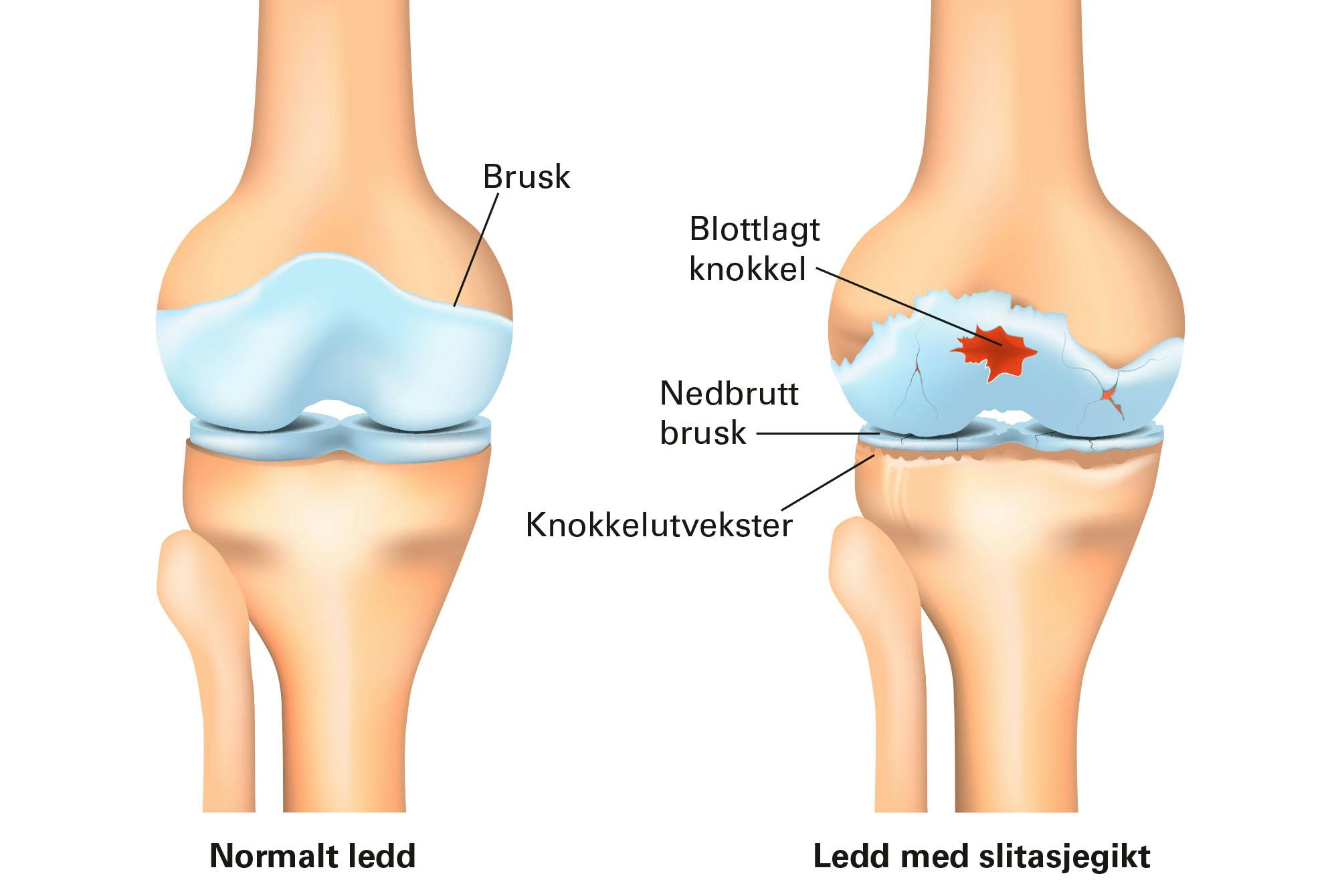 Grafisk fremstilling av ledd med artrose